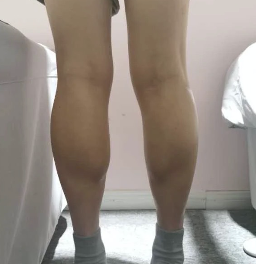 【肉毒瘦小腿】肉毒瘦腿有感分享！精準施打改善小腿肌！ - 康橋診所-台中診所推薦