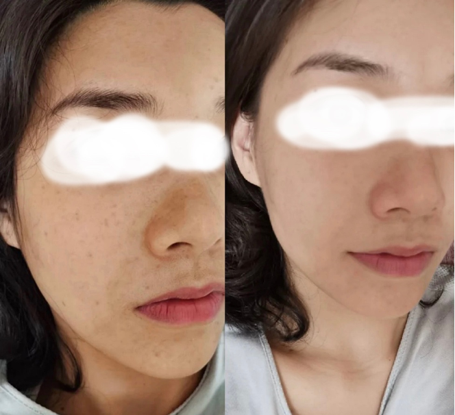 【皮秒雷射】打皮秒超快改善問題肌！處理皮膚問題一定要打探索皮秒！ - 康橋診所-台中診所推薦