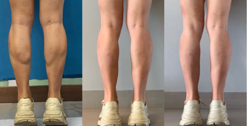 【肉毒瘦小腿】線條都順了！感謝醫美肉毒拯救我的壯壯小粗腿！ - 康橋診所-台中診所推薦