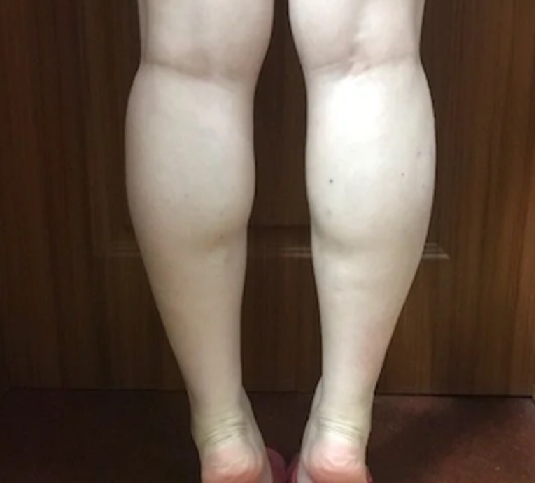 【肉毒瘦小腿】深淺式施打讓小豬腿變小鹿腿！最棒的瘦腿好方法！ - 康橋診所-台中診所推薦