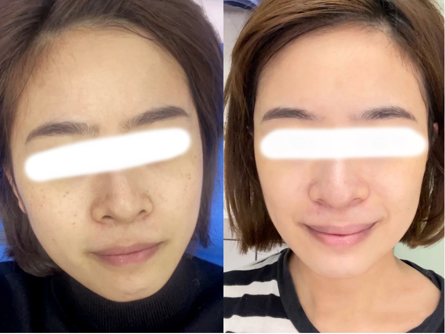 【皮秒雷射】做醫美的好選擇✨漂亮打擊黑色素！想變美心動就要趕快行動！！ - 康橋診所-台中診所推薦
