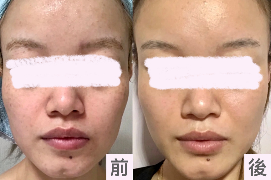 【皮秒雷射】打皮秒雷射處理皮膚科沒解決的問題！治療真的不是選便宜的就好！ - 康橋診所-台中診所推薦