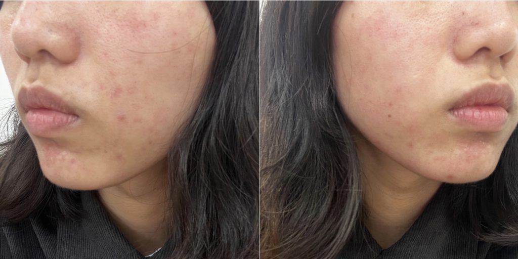 【皮秒雷射】簡單一招治療毛孔粗大和痘疤！超細心醫生＆護理師，打皮秒都不怕了～ - 康橋診所-台中診所推薦