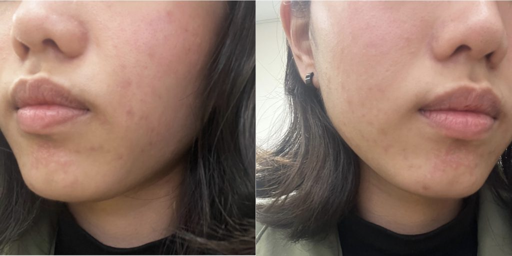 【皮秒雷射】簡單一招治療毛孔粗大和痘疤！超細心醫生＆護理師，打皮秒都不怕了～ - 康橋診所-台中診所推薦