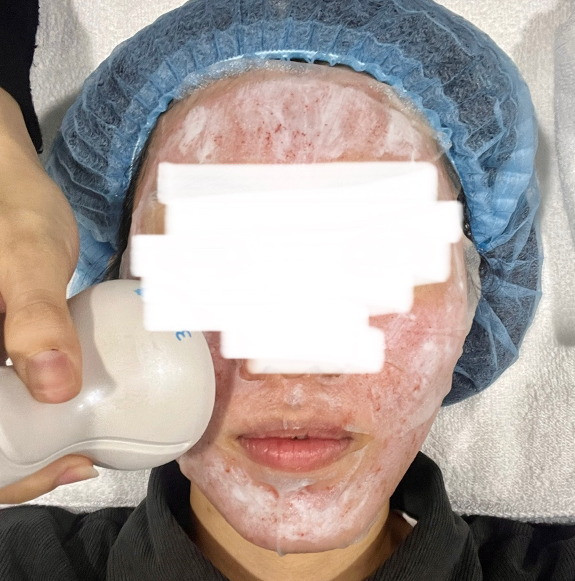 【皮秒雷射】簡單一招治療毛孔粗大和痘疤！超細心醫生＆護理師，打皮秒都不怕了～ - 康橋診所-台中診所推薦