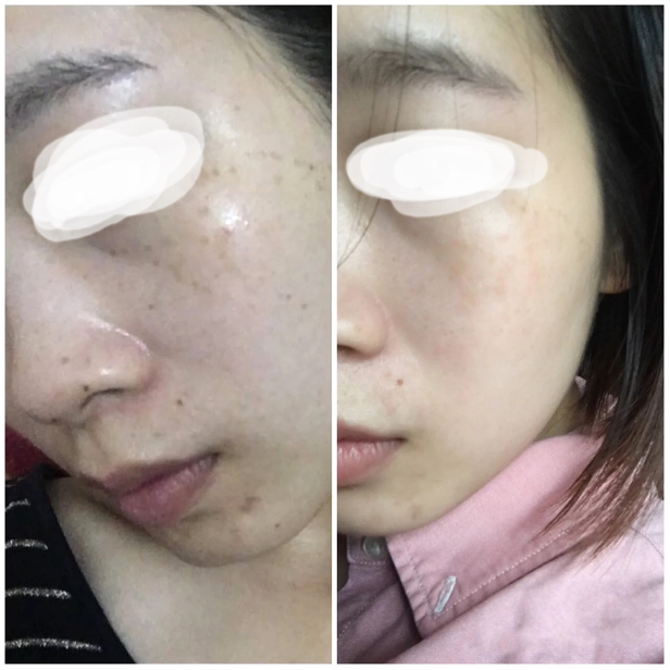 【皮秒雷射】擺脫肝斑、雀斑、曬斑…一堆斑！打皮秒最好的選擇！ - 康橋診所-台中診所推薦