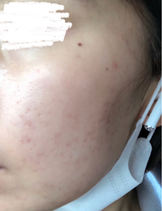 【皮秒雷射】長痘痘可以打皮秒雷射嗎？痘痘臉的皮秒雷射推薦！ - 康橋診所-台中診所推薦