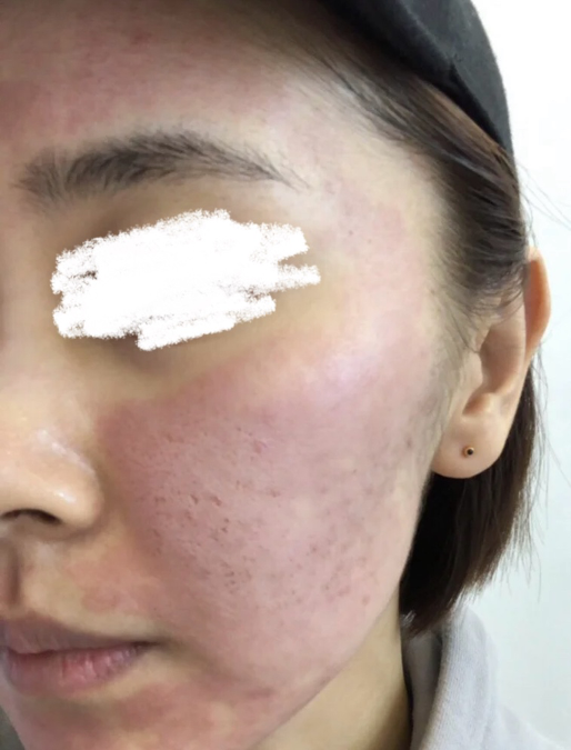 【皮秒雷射】長痘痘可以打皮秒雷射嗎？痘痘臉的皮秒雷射推薦！ - 康橋診所-台中診所推薦