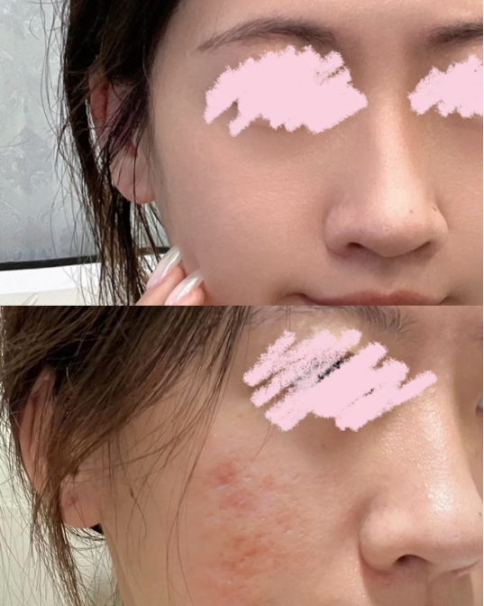 【皮秒雷射】長痘痘可以打皮秒雷射嗎？痘痘臉的皮秒雷射推薦！ - 康橋診所-台中診所推薦