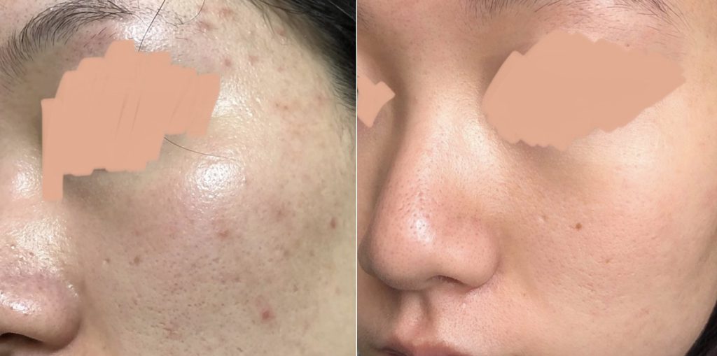 【皮秒雷射】終於去打了皮秒雷射，改善毛孔粗大＆痘疤問題超有效！！ - 康橋診所-台中診所推薦