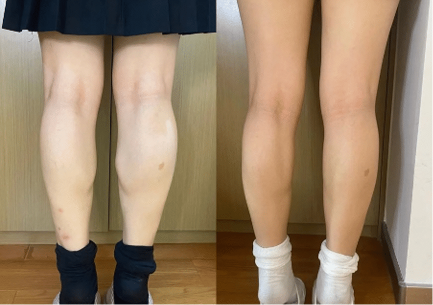 【肉毒瘦腿】打肉毒瘦小腿真的有用！告別肌肉腿！推薦台中超優質醫美～ - 康橋診所-台中診所推薦
