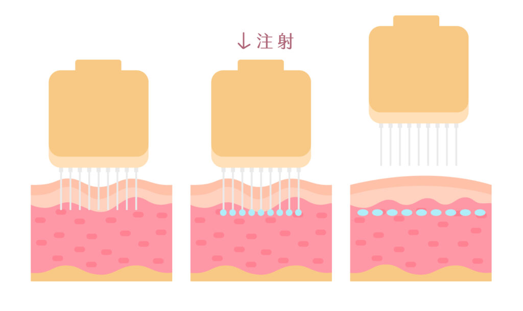 水光針／水光槍是什麼？水光針是很有效，但怎麼打才能降低水光針後遺症？ - 康橋診所-台中診所推薦