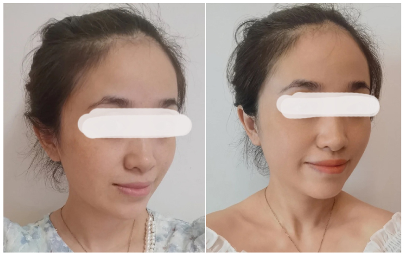 【皮秒雷射】探索皮秒拯救小花臉！台中高CP值醫美就推這家！！ - 康橋診所-台中診所推薦