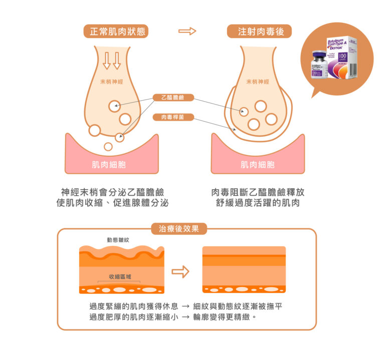 Botox美國保妥適肉毒 - 康橋診所-台中診所推薦 五星評論診所 6 Botox美國保妥適肉毒 - 康橋診所-台中診所推薦