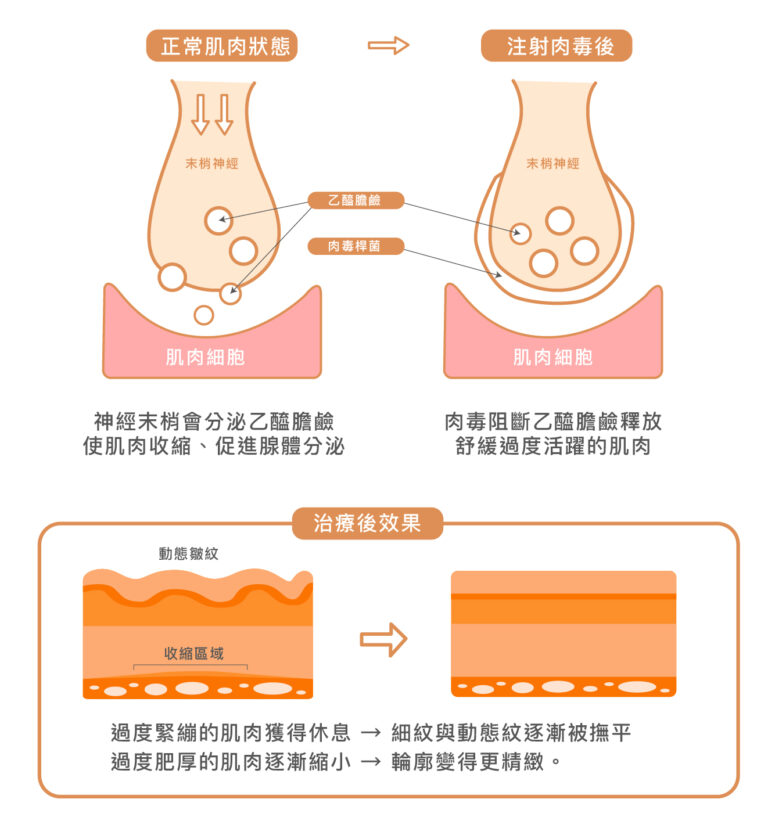 Letybo 保提拉肉毒 - 康橋診所-台中診所推薦 五星評論診所 6 Letybo 保提拉肉毒 - 康橋診所-台中診所推薦