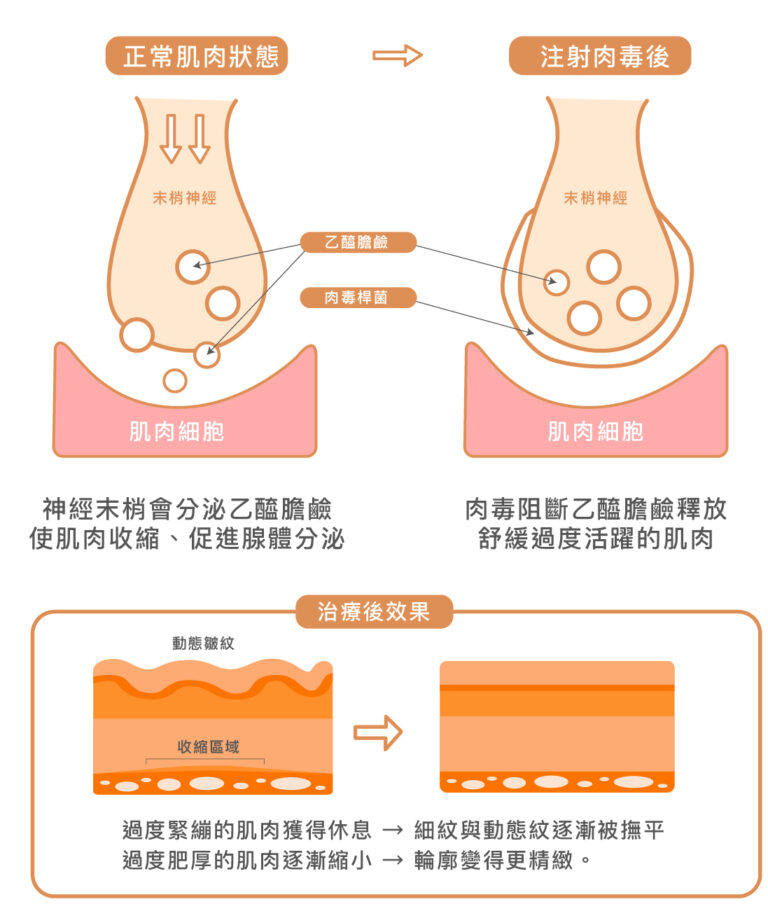 NABOTA彩虹肉毒 - 康橋診所-台中診所推薦 五星評論診所 6 NABOTA彩虹肉毒 - 康橋診所-台中診所推薦