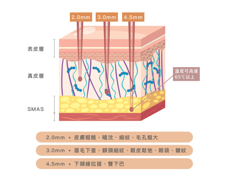Uliftra 優芙納音波 - 康橋診所-台中診所推薦 五星評論診所 21 Uliftra 優芙納音波 - 康橋診所-台中診所推薦
