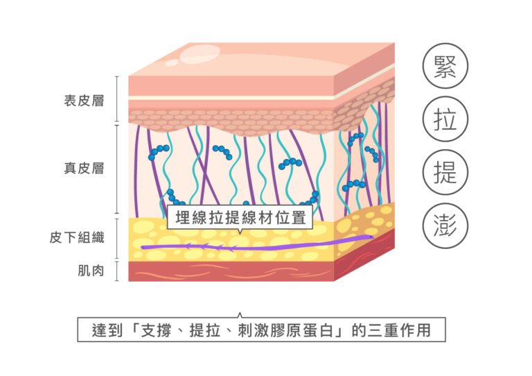 埋線拉提 - 康橋診所-台中診所推薦 五星評論診所 15 埋線拉提 - 康橋診所-台中診所推薦