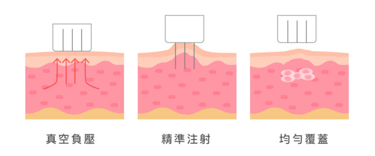 水光針Vital Injector 2 - 康橋診所-台中診所推薦 五星評論診所 5 水光針Vital Injector 2 - 康橋診所-台中診所推薦
