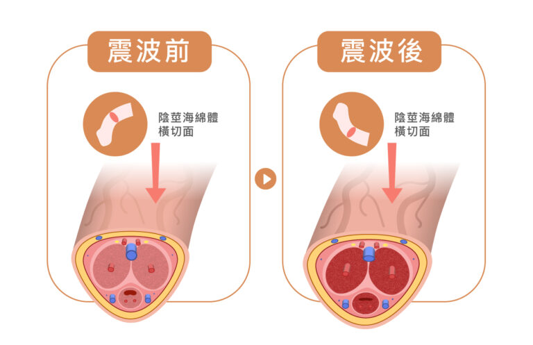 LI-ESWT低能量體外震波 - 康橋診所-台中診所推薦 五星評論診所 8 LI-ESWT低能量體外震波 - 康橋診所-台中診所推薦